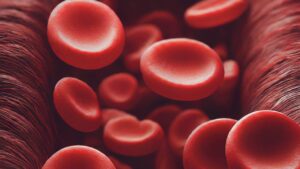 Anemia