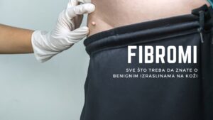 Fibromi, benigne izrasline na koži