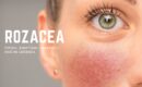 Rozacea na licu